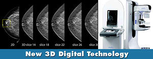 digital mammography tomosynthesis